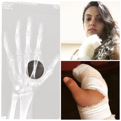 Poliana Botelho mostra lesão na mão direita, razão por sua retirada do card do UFC 206. (Foto: Instagram @PolianaBotelho)